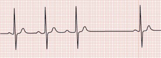 窦性心动过缓,窦性心动过缓怎么办,窦性心律,心动过缓,心肌缺血,心律
