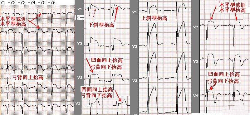 st段,st段改变,st段抬高,st段压低,st段缩短,st段延长,t波改变,心肌