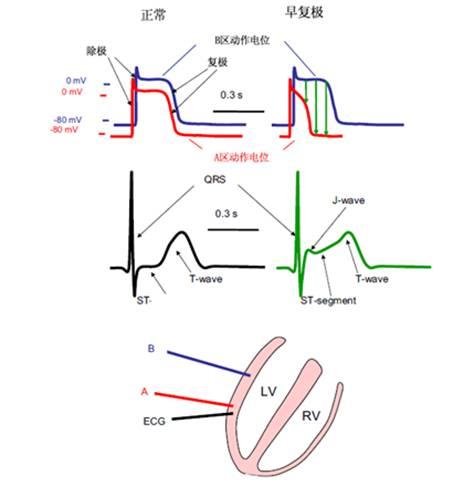 ers,早期复极综合征,提早复极综合征,心电复极异常,交感神经,brugada
